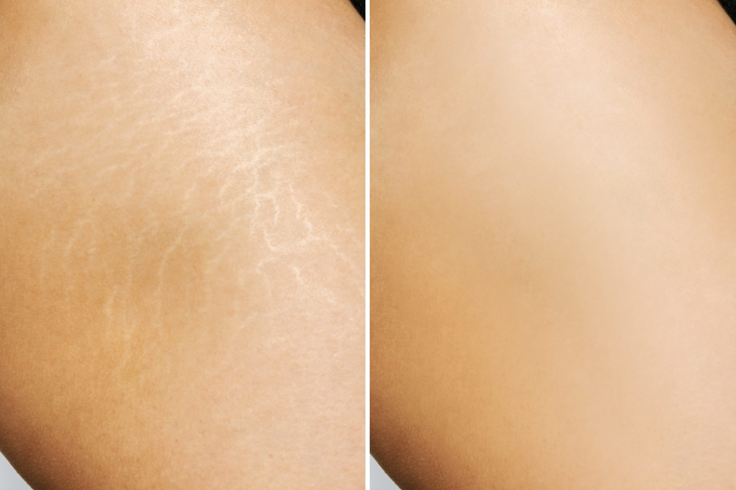 Stretch Marks Removal Before & after Treatment in Idaho Falls, ID By Bella Jade Medspa