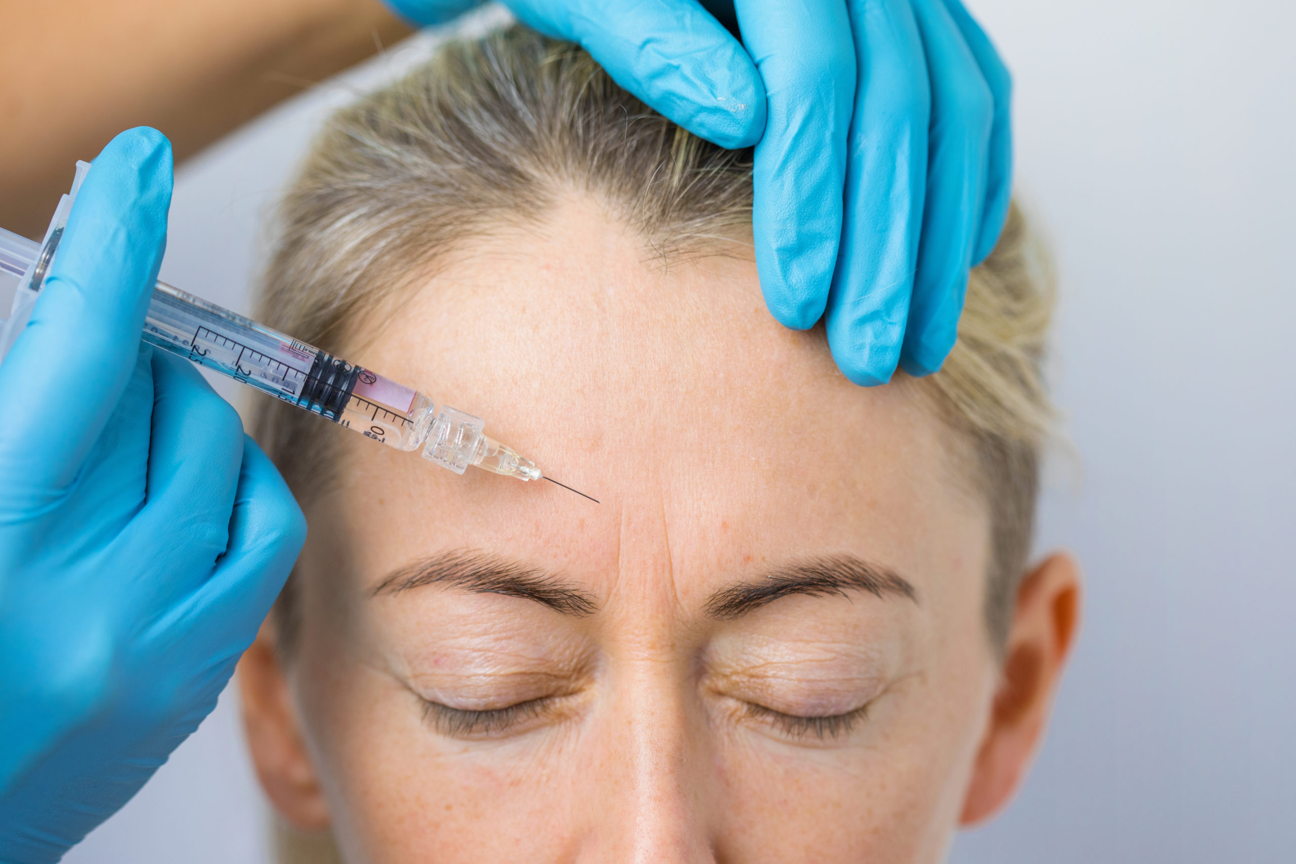Beyond Wrinkle Reduction: Surprising Uses of BOTOX You Didn't Know About