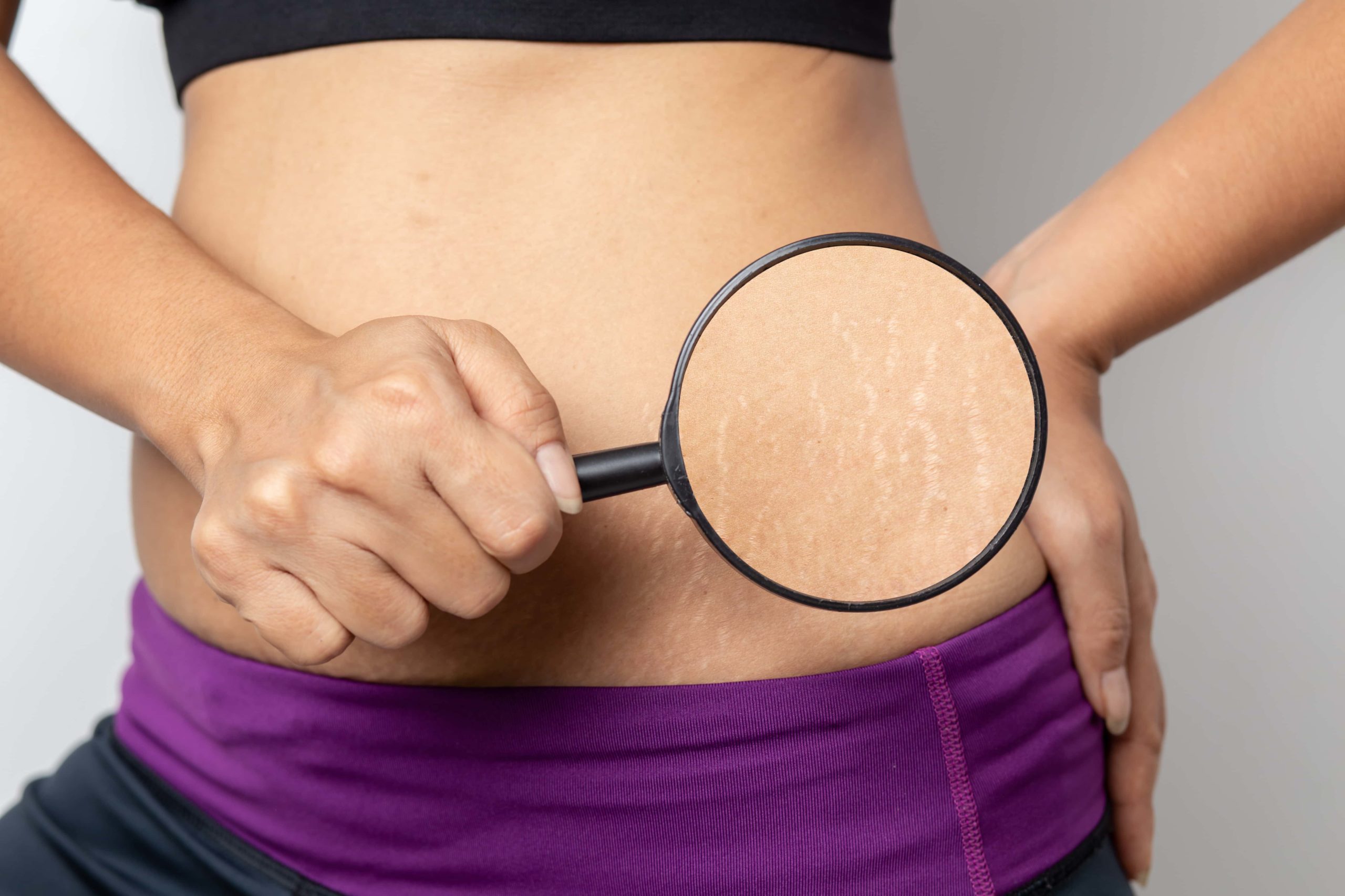 How Can I Get Rid of Stretch Marks Permanently