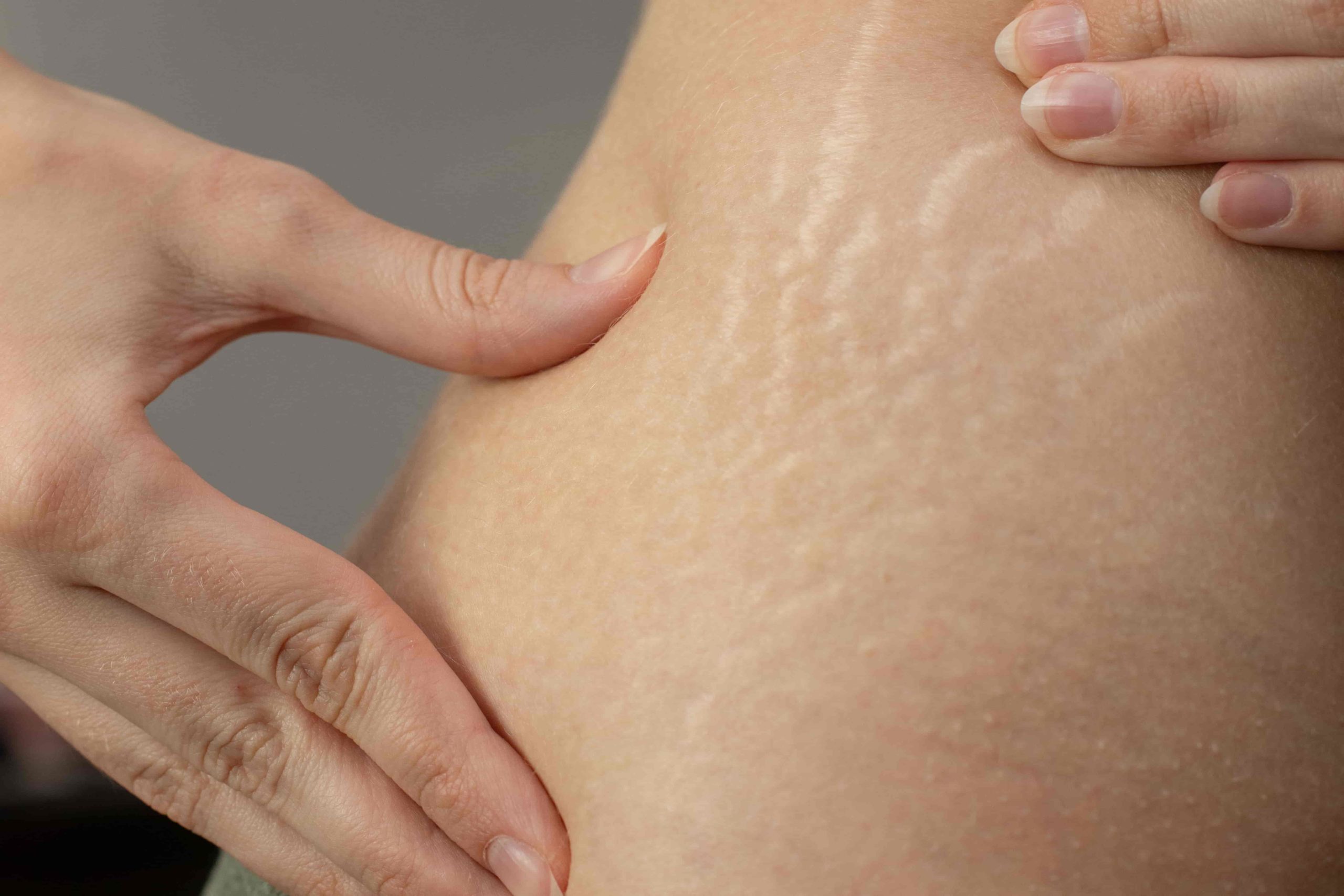 Stretch Marks During and After Pregnancy
