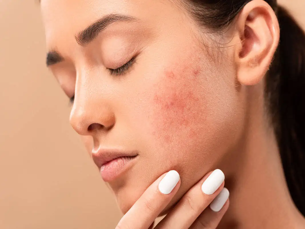 acne scars by bella jade medspa